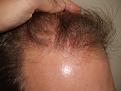 Click image for larger version

Name:	After Hairline.jpg
Views:	491
Size:	96.0 KB
ID:	451731