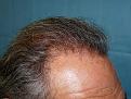 Click image for larger version

Name:	post-op 05.jpg
Views:	551
Size:	73.6 KB
ID:	451916