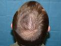 Click image for larger version

Name:	post-op 009.jpg
Views:	583
Size:	54.7 KB
ID:	452007
