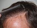 Click image for larger version

Name:	After Hairline.jpg
Views:	512
Size:	96.0 KB
ID:	452053