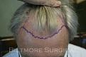 Click image for larger version

Name:	SS a preop.jpg
Views:	568
Size:	17.4 KB
ID:	452241