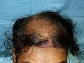 Click image for larger version

Name:	1 Day Post-op 01.jpg
Views:	453
Size:	73.8 KB
ID:	452258