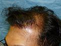 Click image for larger version

Name:	1 Day Post-op 03.jpg
Views:	426
Size:	71.0 KB
ID:	452260