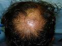 Click image for larger version

Name:	1 Day Post-op 04.jpg
Views:	450
Size:	78.7 KB
ID:	452261