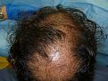 Click image for larger version

Name:	1 Day Post-op 05.jpg
Views:	440
Size:	81.2 KB
ID:	452262