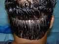 Click image for larger version

Name:	1 Day Post-op 06.jpg
Views:	450
Size:	96.1 KB
ID:	452263