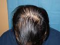 Click image for larger version

Name:	8 months post-op 10.jpg
Views:	449
Size:	63.3 KB
ID:	452273