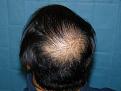 Click image for larger version

Name:	8 months post-op 11.jpg
Views:	467
Size:	53.3 KB
ID:	452274