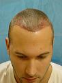 Click image for larger version

Name:	1 day post-op.jpg
Views:	555
Size:	94.3 KB
ID:	452372
