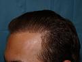 Click image for larger version

Name:	18 months post-op 04.jpg
Views:	517
Size:	47.5 KB
ID:	452376