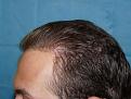 Click image for larger version

Name:	18 months post-op 06.jpg
Views:	474
Size:	65.5 KB
ID:	452378