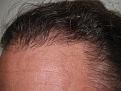 Click image for larger version

Name:	Before Hairline.jpg
Views:	476
Size:	95.7 KB
ID:	452444