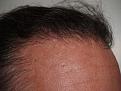 Click image for larger version

Name:	After Hairline.jpg
Views:	384
Size:	95.4 KB
ID:	452447