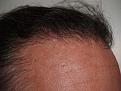 Click image for larger version

Name:	After Hairline.jpg
Views:	476
Size:	95.4 KB
ID:	452447