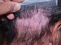 Click image for larger version

Name:	Before Scar Repair.jpg
Views:	1025
Size:	96.5 KB
ID:	452448