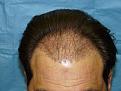 Click image for larger version

Name:	one day post-op 01.jpg
Views:	444
Size:	57.2 KB
ID:	452520