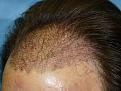 Click image for larger version

Name:	one day post-op 03.jpg
Views:	434
Size:	73.0 KB
ID:	452522