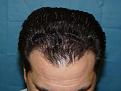 Click image for larger version

Name:	8 months post-op 02.jpg
Views:	465
Size:	53.4 KB
ID:	452525