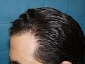 Click image for larger version

Name:	8 months post-op 03.jpg
Views:	469
Size:	68.0 KB
ID:	452526