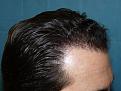 Click image for larger version

Name:	8 months post-op 05.jpg
Views:	450
Size:	64.1 KB
ID:	452528