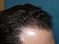 Click image for larger version

Name:	8 months post-op 06.jpg
Views:	488
Size:	67.2 KB
ID:	452529
