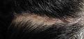 Click image for larger version

Name:	browlift bad 2r.jpg
Views:	606
Size:	33.6 KB
ID:	452544