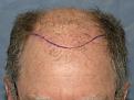 05_position-of-hairline.jpg