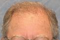06_after-1st-hair-transplant.jpg