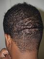 Click image for larger version

Name:	After FUE Donor Scar.jpg
Views:	616
Size:	97.0 KB
ID:	452724