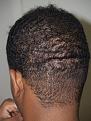 Click image for larger version

Name:	After FUE Donor Scar.jpg
Views:	692
Size:	97.0 KB
ID:	452724