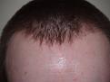 Click image for larger version

Name:	10 Months After Hairline.jpg
Views:	406
Size:	95.8 KB
ID:	452732