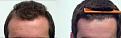 Click image for larger version

Name:	Front before and after hair held back.jpg
Views:	1676
Size:	100.8 KB
ID:	452752