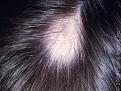 Click image for larger version

Name:	alopeciaAreata_33329_lg.jpg
Views:	384
Size:	18.8 KB
ID:	452803