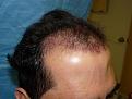 Click image for larger version

Name:	1 day post-op 002.jpg
Views:	425
Size:	53.5 KB
ID:	452842