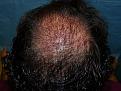 Click image for larger version

Name:	1 day post-op 003.jpg
Views:	432
Size:	77.0 KB
ID:	452843