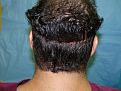 Click image for larger version

Name:	1 day post-op 004.jpg
Views:	420
Size:	74.4 KB
ID:	452844