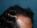 Click image for larger version

Name:	8 months post-op 05.jpg
Views:	415
Size:	53.7 KB
ID:	452849