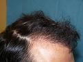 Click image for larger version

Name:	8 months post-op 06.jpg
Views:	419
Size:	68.2 KB
ID:	452850