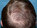 Click image for larger version

Name:	10 months post-op 11.jpg
Views:	289
Size:	96.8 KB
ID:	452869