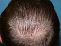Click image for larger version

Name:	10 months post-op 12.jpg
Views:	297
Size:	86.9 KB
ID:	452870