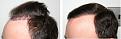 Click image for larger version

Name:	before-after2-11 mos.jpg
Views:	739
Size:	95.7 KB
ID:	453016