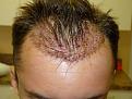 Click image for larger version

Name:	1day post-op 01.jpg
Views:	512
Size:	65.1 KB
ID:	453149