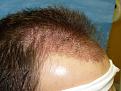 Click image for larger version

Name:	day of procedure 03.jpg
Views:	400
Size:	73.2 KB
ID:	453239