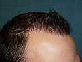 Click image for larger version

Name:	10 months post-op 05.jpg
Views:	366
Size:	50.0 KB
ID:	453245