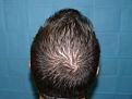 Click image for larger version

Name:	10 months post-op 07.jpg
Views:	357
Size:	52.6 KB
ID:	453247