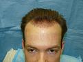 Click image for larger version

Name:	1 day post-op 010.jpg
Views:	296
Size:	43.6 KB
ID:	453427