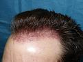 Click image for larger version

Name:	1 day post-op 020.jpg
Views:	282
Size:	59.2 KB
ID:	453428