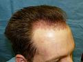 Click image for larger version

Name:	1 day post-op 030.jpg
Views:	286
Size:	54.6 KB
ID:	453429