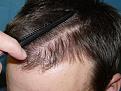 Click image for larger version

Name:	10 months post-op 07.jpg
Views:	285
Size:	75.6 KB
ID:	453433