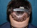 Click image for larger version

Name:	10 months post-op 12.jpg
Views:	281
Size:	94.9 KB
ID:	453436